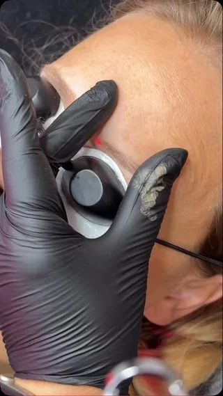 Laser removal on old brow pigment
