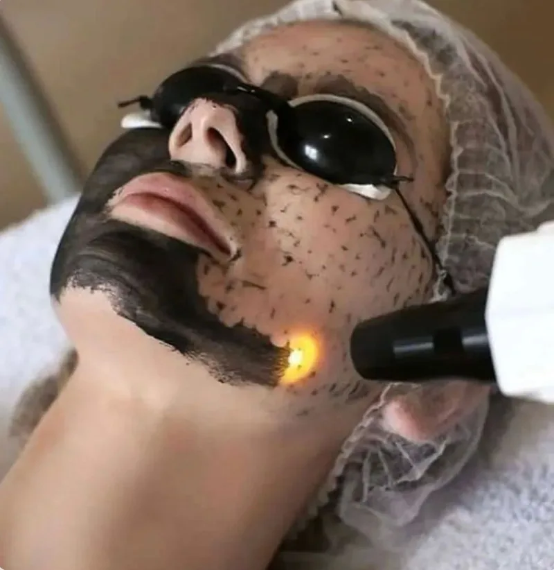 Carbon Hollywood peel, a laser pass shattering the carbon mask on the skin